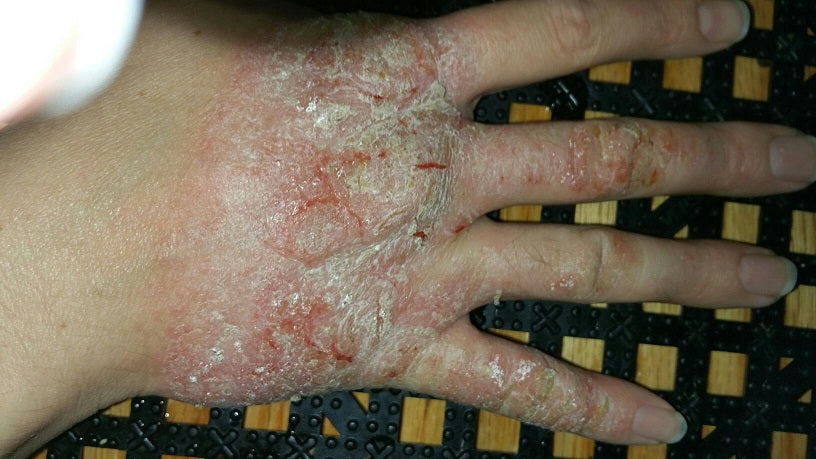 Difference Between Eczema and Psoriasis...