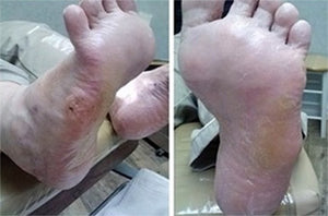 Improved Feet After Formula 2