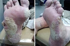 Severely Dry Cracked Feet